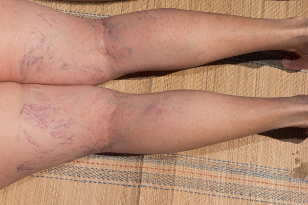 Laser Vein Treatment: Safe, Effective, and almost Painless